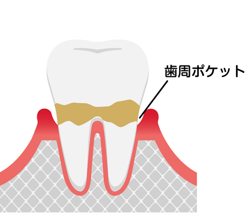 当院の歯周病治療について