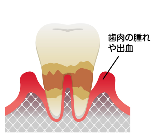 当院の歯周病治療について