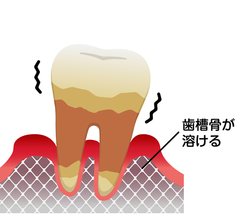 当院の歯周病治療について